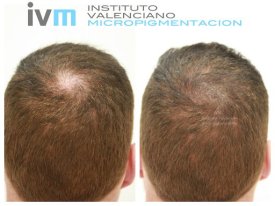 TRICO-IVM-9