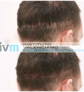 TRICO-IVM-6