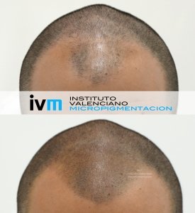 TRICO-IVM