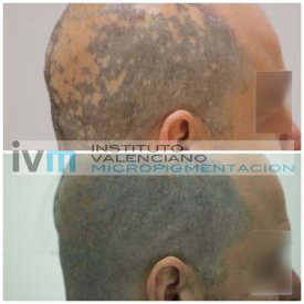TRICO-IVM-11