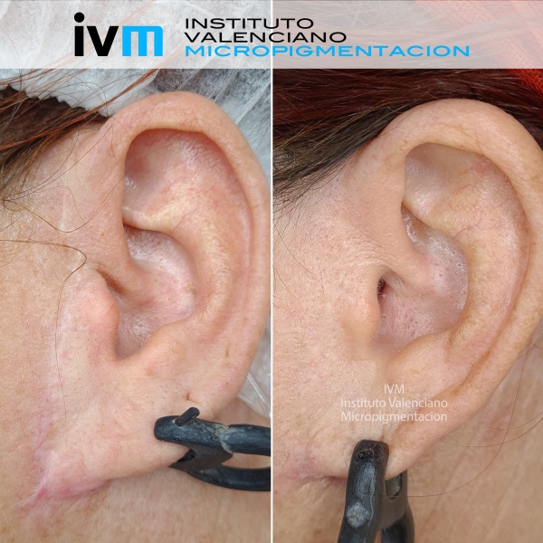 Cicatriz_oreja_IVM