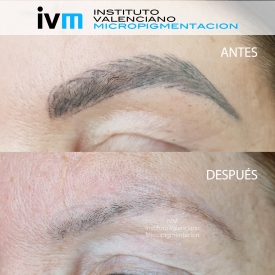 ELIMINACION_IVM
