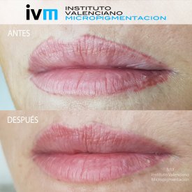ELIMINACION_IVM