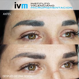 ELIMINACION_IVM