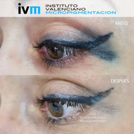 ELIMINACION_IVM
