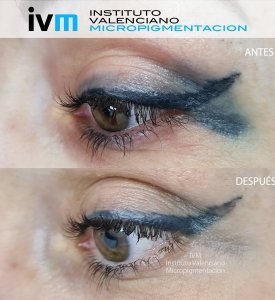 ELIMINACION_IVM