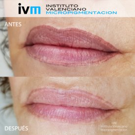 ELIMINACION_IVM