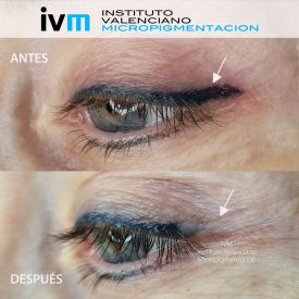 ELIMINACION_IVM