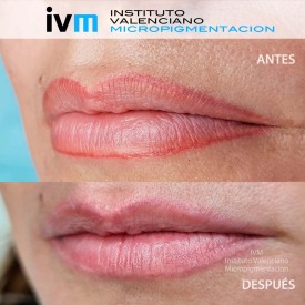 IVM_REJUVI_LABIOS-AYD