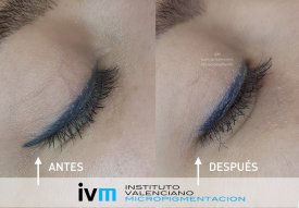 ELIMINACION_IVM