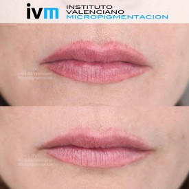 ELIMINACION_IVM