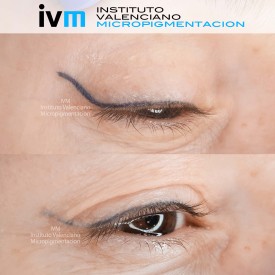 ELIMINACION_IVM