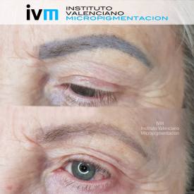 IVM_REJUVI_LABIOS-AYD