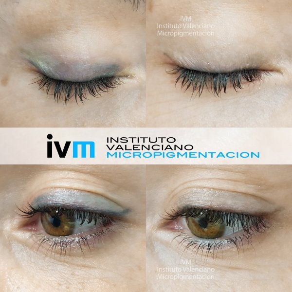 ELIMINACION_IVM