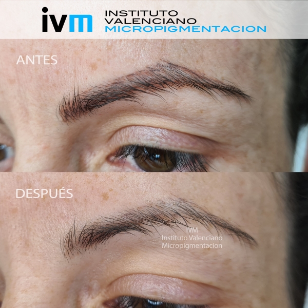 ELIMINACION_IVM