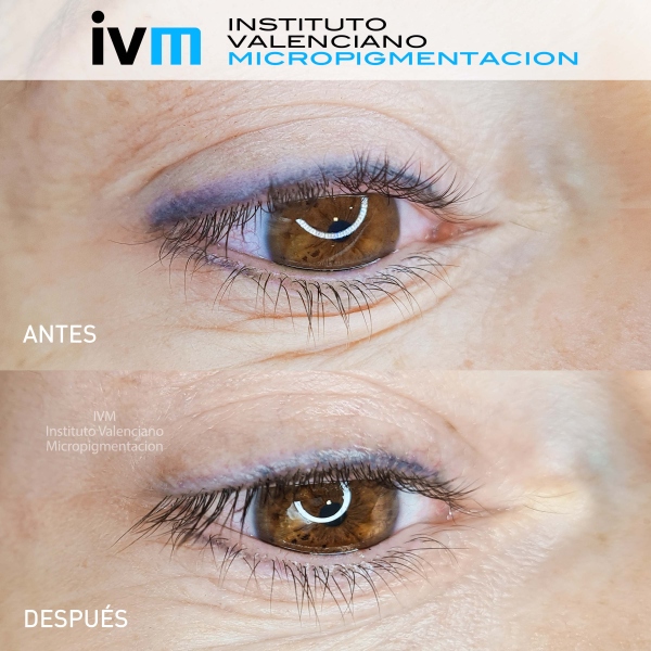 ELIMINACION_IVM