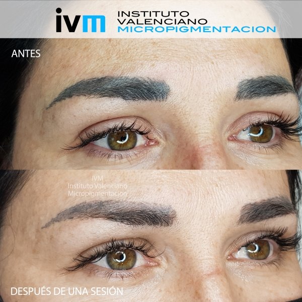 ELIMINACION_IVM