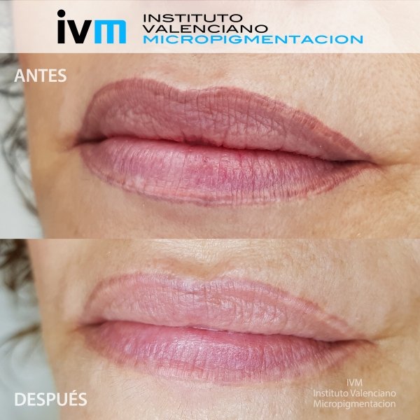 ELIMINACION_IVM