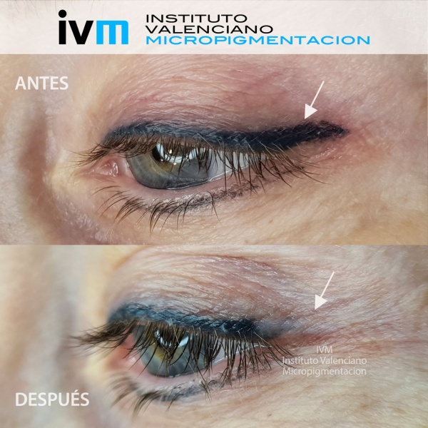 ELIMINACION_IVM