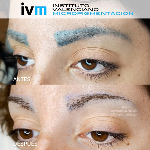ELIMINACION_IVM