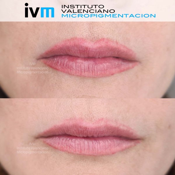 ELIMINACION_IVM