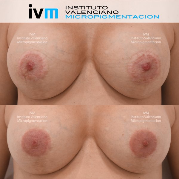 Reconstruccion-Areola-IVM