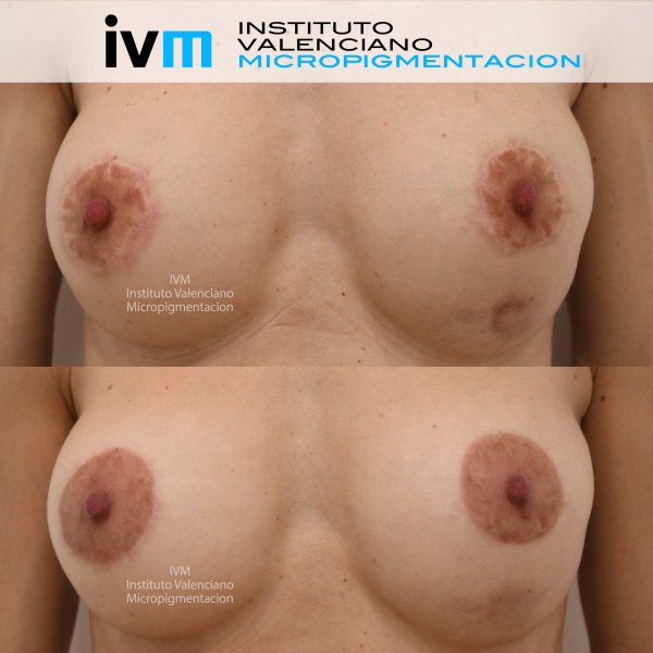 Reconstruccion-Areola-IVM