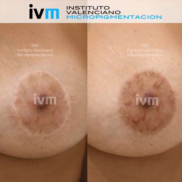 Reconstruccion-Areola-IVM