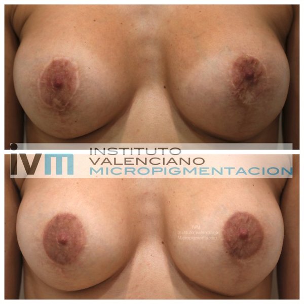 Camuflaje-Cicatrices-Areola-IVM