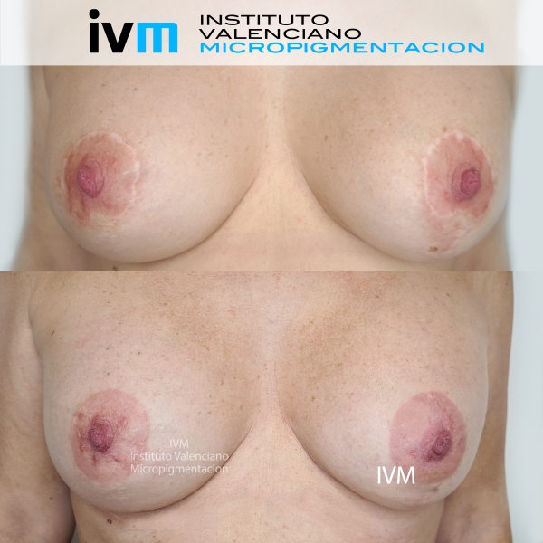 Reconstruccion-Areola-IVM