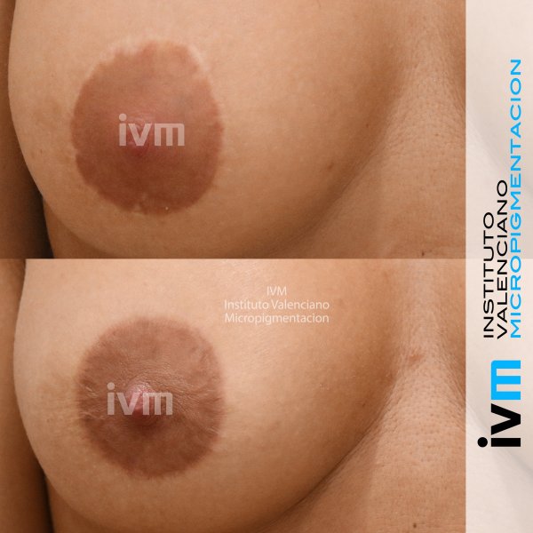 Reconstruccion-Areola-IVM