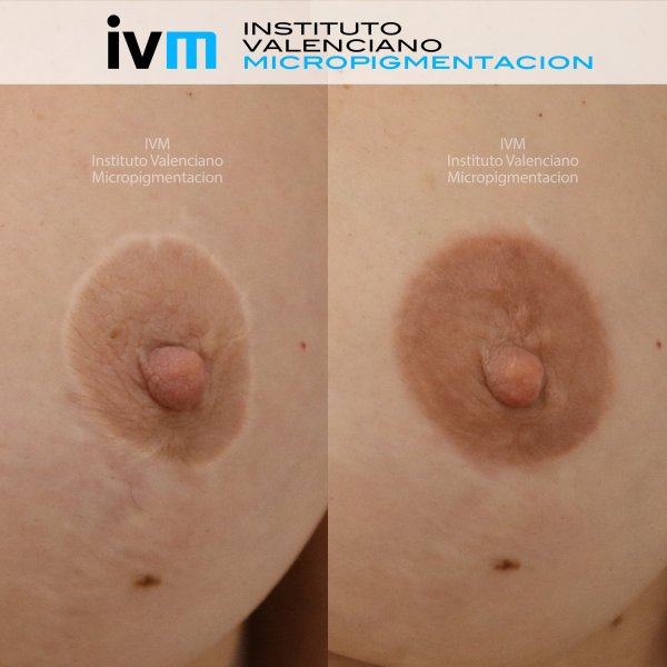 Reconstruccion-Areolas-IVM