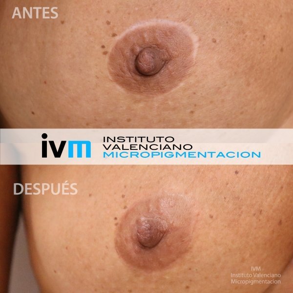 Reconstruccion-Areola-IVM