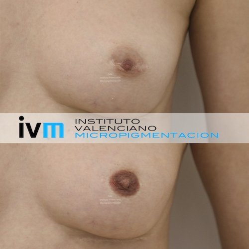 Reconstruccion-Areola-IVM