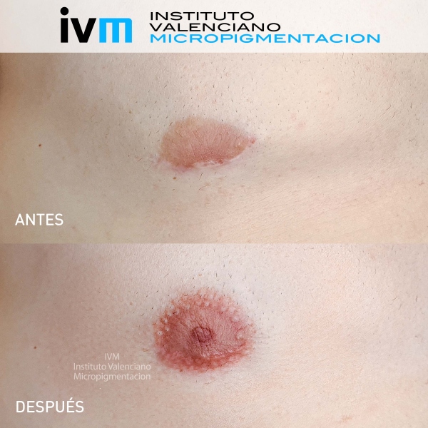 Reconstruccion-Areola-Masculino-IVM