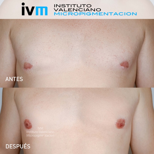 Reconstruccion-Areola-Masculino-IVM