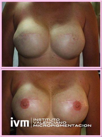 Recontrucciona-Areolas-IVM-3