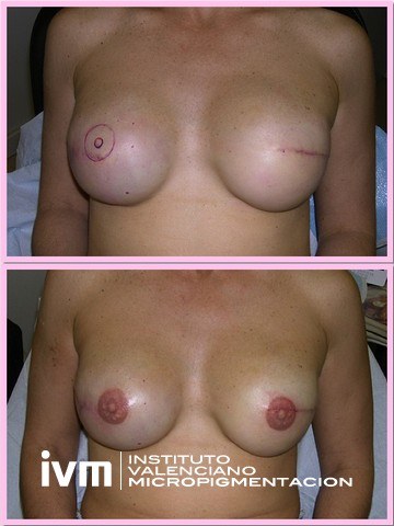 Recontrucciona-Areolas-IVM-4