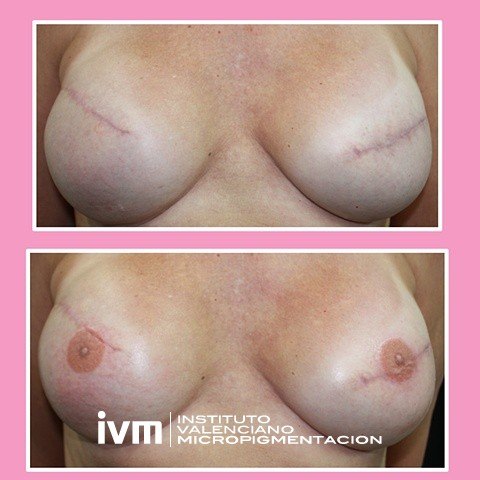 Recontrucciona-Areolas-IVM-6