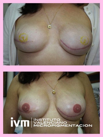 Recontrucciona-Areolas-IVM-10