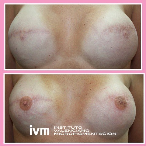 Recontrucciona-Areolas-IVM-11