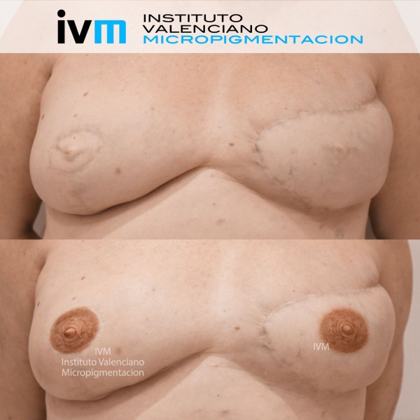 Reconstruccion-Areola-IVM