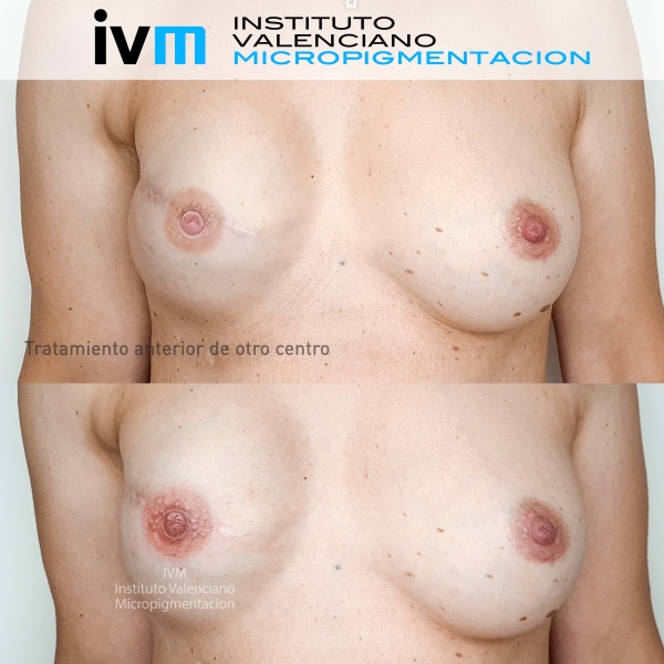 Reconstruccion-Areola-IVM