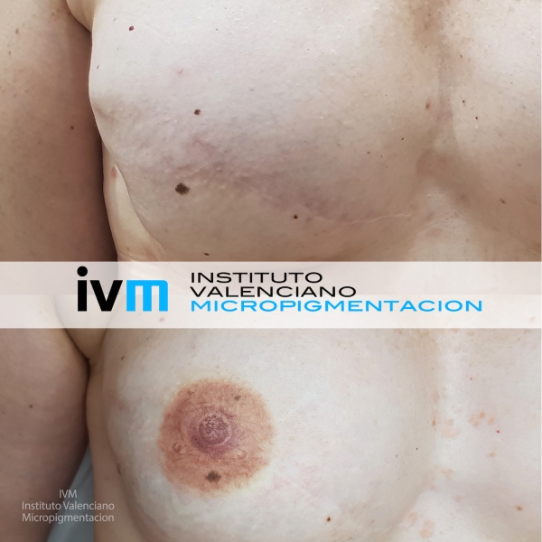 Reconstruccion-Areolas-IVM