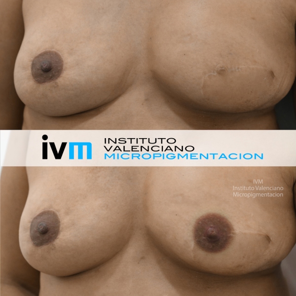 Reconstruccion-Areolas-IVM