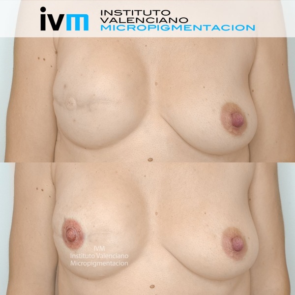 Reconstruccion-Areola-IVM