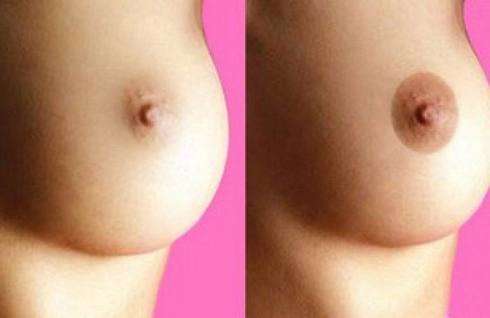 areolas1