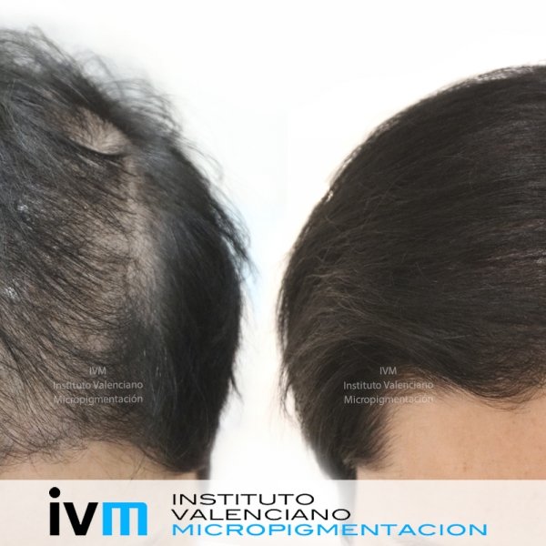 TRICO-IVM-2