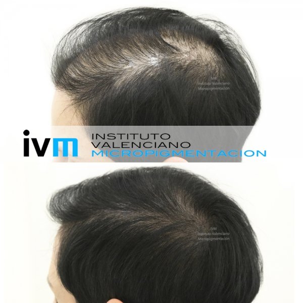 TRICO-IVM-2