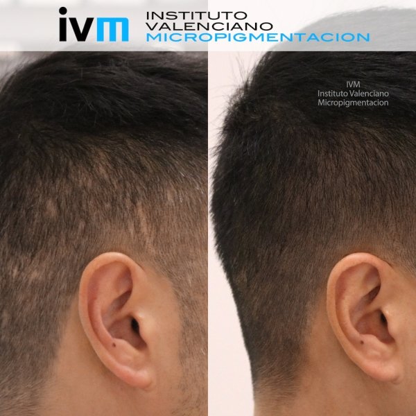 TRICO-IVM